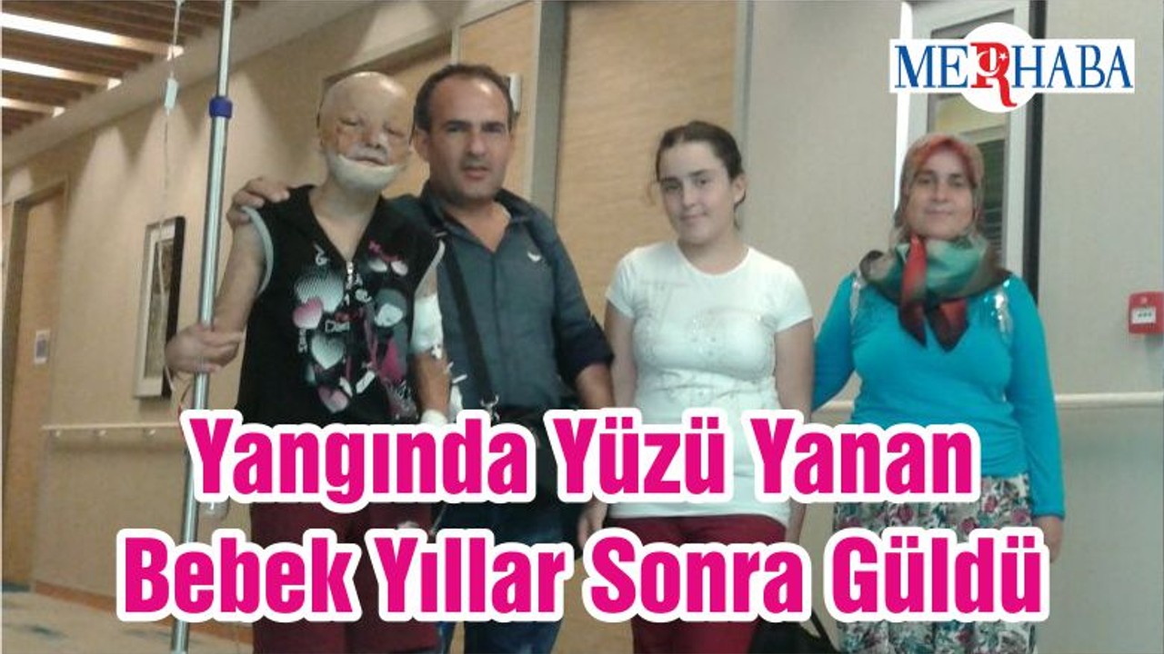 Yangında Yüzü Yanan Bebek Yıllar Sonra Güldü