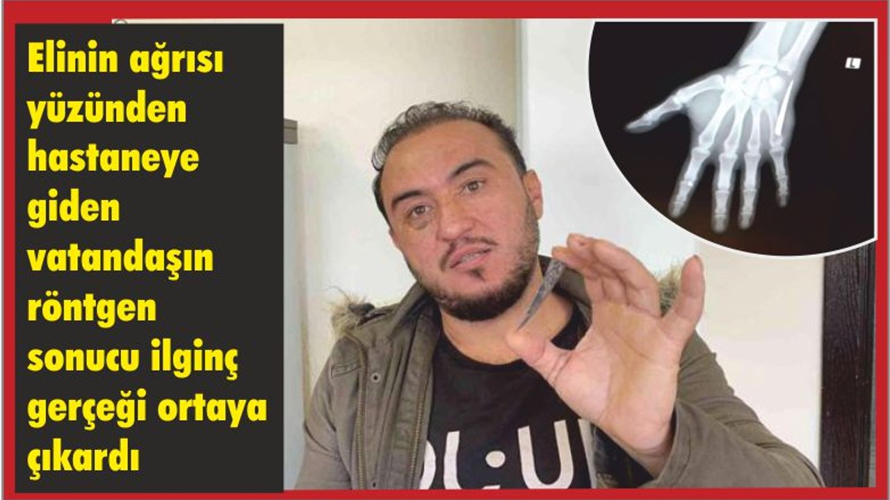 Eli Ağrıyordu, Hastanede İlginç Gerçeği Öğrendi
