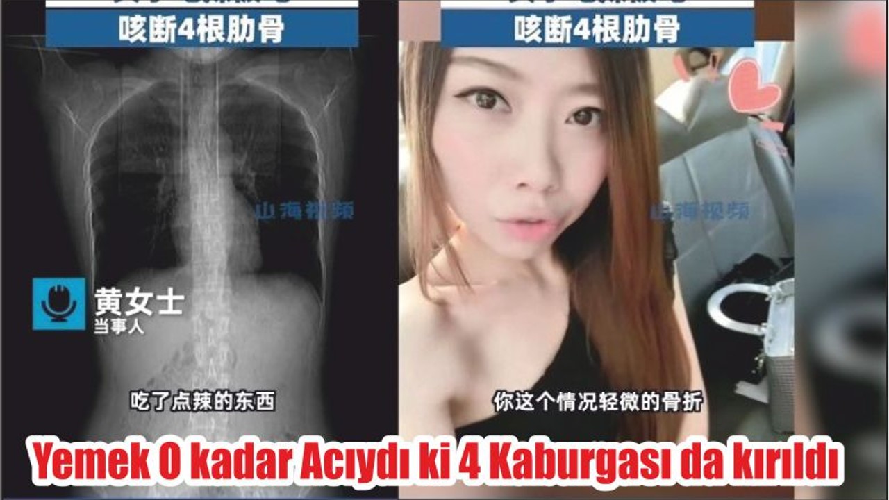 Yemek o kadar acıydı ki 4 kaburgası çatladı