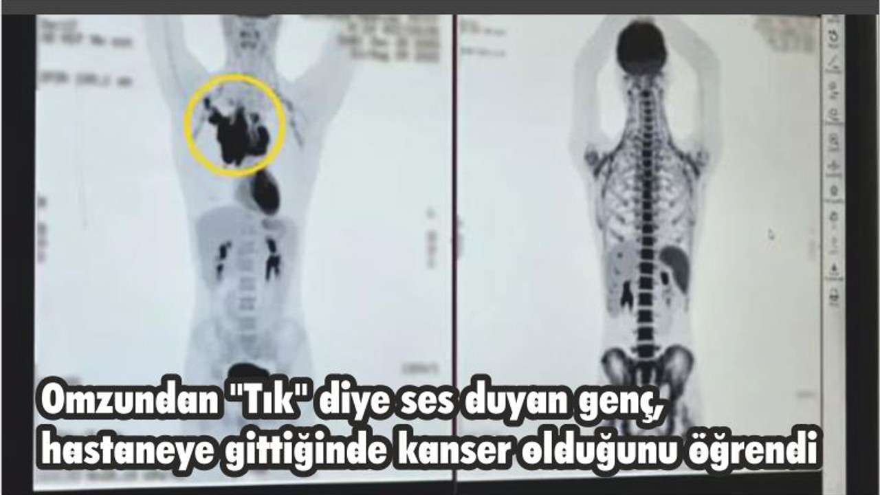 Omzundan "Tık" diye ses duyan genç, hastaneye gittiğinde kanser olduğunu öğrendi