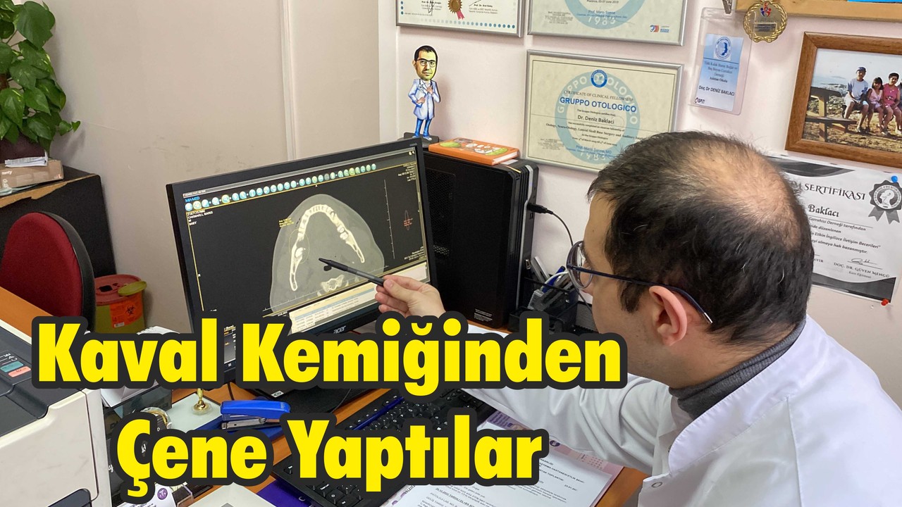 Kaval Kemiğinden Çene Yaptılar