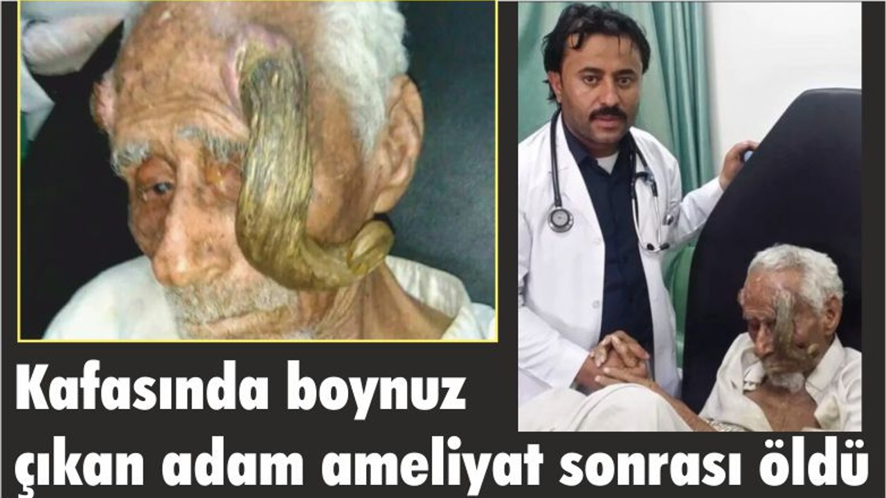 Kafasında boynuz çıkan adam ameliyat sonrası öldü