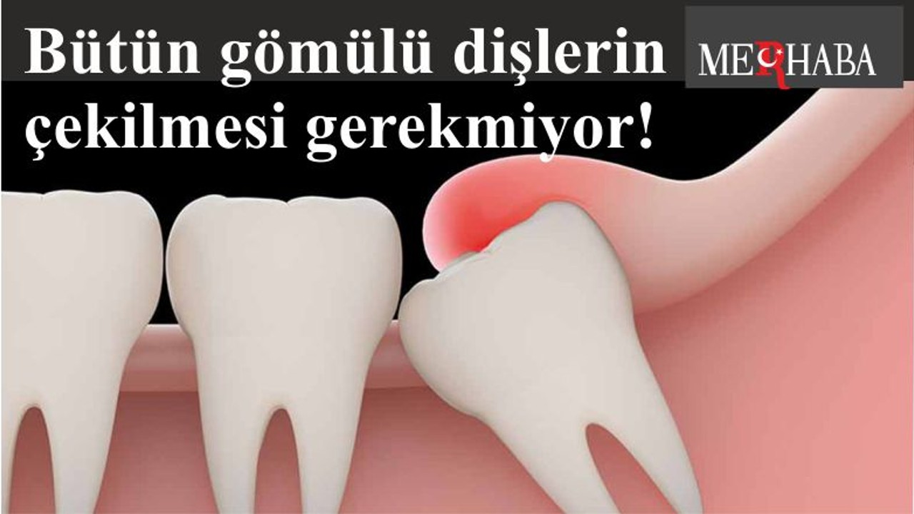 Bütün gömülü dişlerin çekilmesi gerekmiyor!