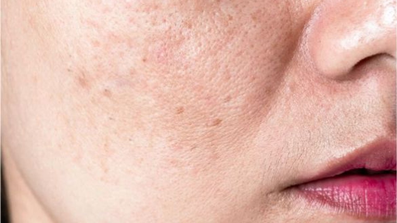 Sebum Dengesi Nasıl Korunur?