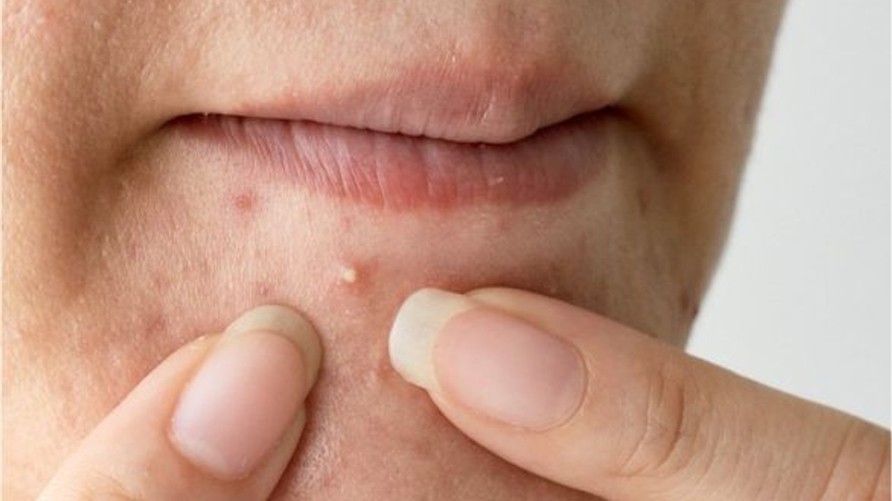 Hormonal Akne Nedir?