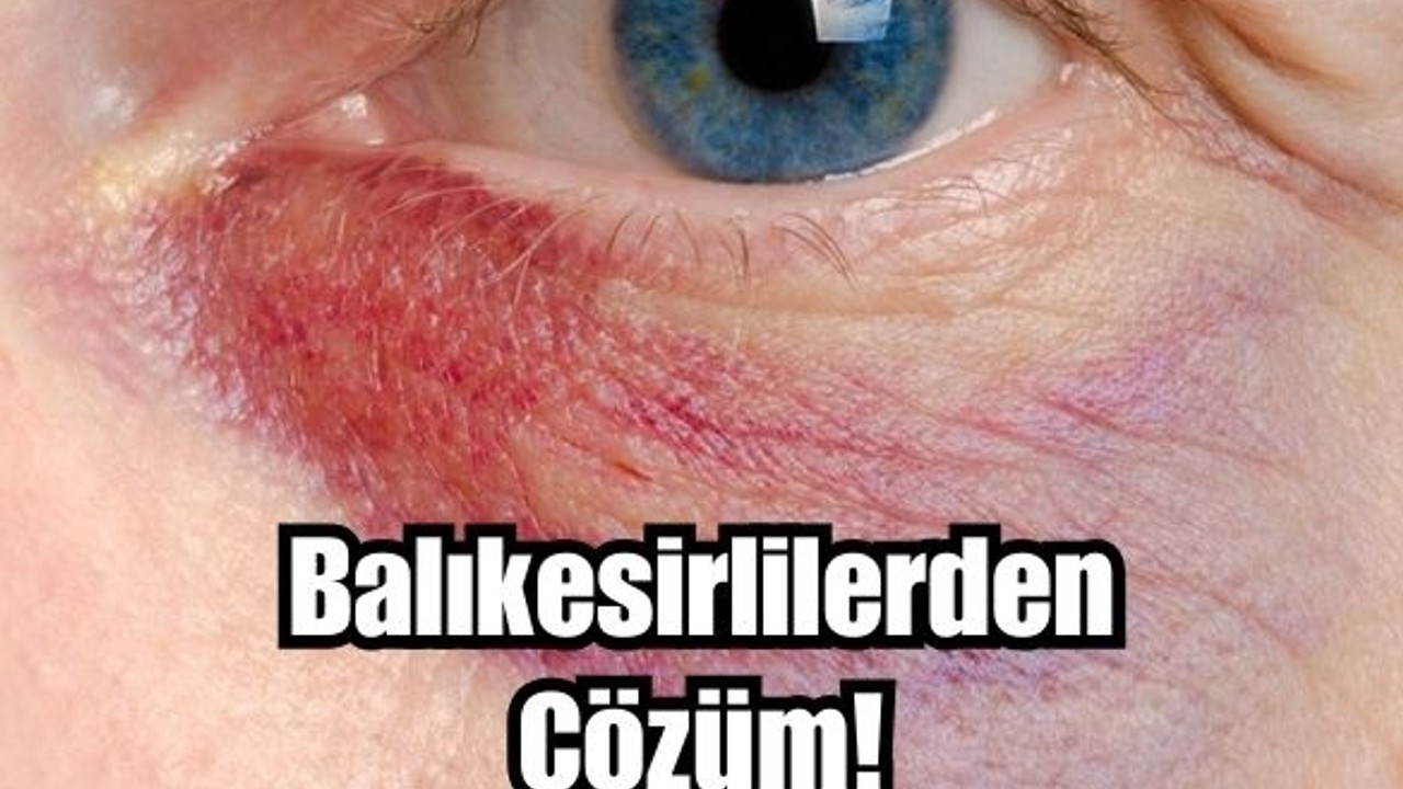 Gözaltı Morluklarına Balıkesirli Kadınların Sırrı