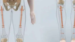 Bel ve ayak ağrısı çeken hasta, boy uzatma ameliyatıyla sağlığına kavuştu