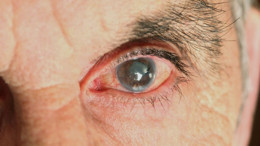 Glokom Nedir ve Neden Önemlidir?