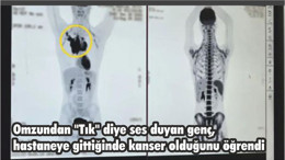 Omzundan "Tık" diye ses duyan genç, hastaneye gittiğinde kanser olduğunu öğrendi