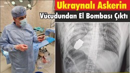 Ukraynalı Askerin Vücudundan El Bombası Çıktı