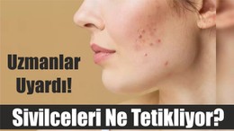 Uzmanlar Uyardı! Sivilceleri Ne Tetikliyor?