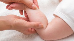Bebeklerinizde Pişik Oluşumunu Engelleyin