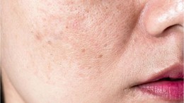 Sebum Dengesi Nasıl Korunur?