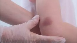 Lösemi Şüphesi Oluşturan 4 Soru