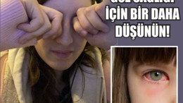 Gözlerimizi Ovalayınca Neden Bulanık Görürüz?