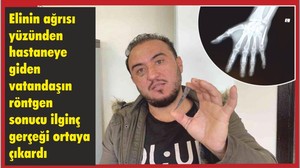 Eli Ağrıyordu, Hastanede İlginç Gerçeği Öğrendi