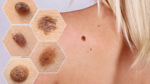 Cilt Kanseri Vakalarında Artış!