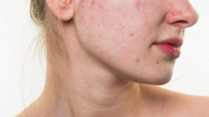 Ergenlik Döneminde Cilt Bakımı