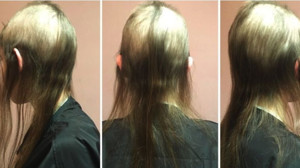 Bu Hastalık Saç Yolduruyor!