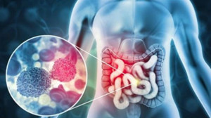 Kolorektal Kanser Nedir ve Yaygın mıdır ?