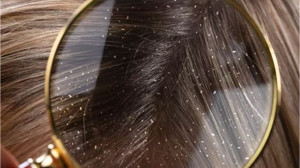 Kepek Oluşumunu Engelleyin!