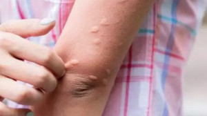 Sivrisinekler O Kan Gruplarına İlgi Duyuyor!