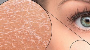 Kuru Cilt Nedir Belirtileri Nelerdir ?