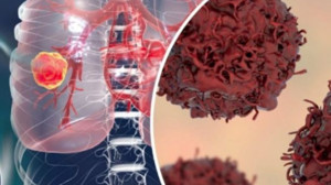 Radyocerrahide "Nokta Atış" Yöntemi