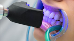 Uzmanlar Uyarıyor! Diş Beyazlatma Kitlerine Dikkat