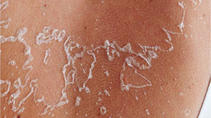 Güneş Yanığı Sonrası Cilt Bakımında 3 Önemli Adım!