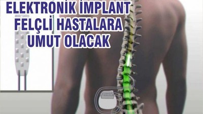 Elektronik İmplant Felç Hastalarına Umut Olacak