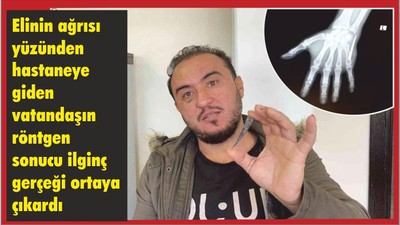 Eli Ağrıyordu, Hastanede İlginç Gerçeği Öğrendi