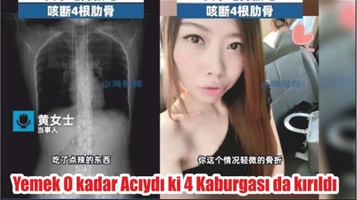 Yemek o kadar acıydı ki 4 kaburgası çatladı