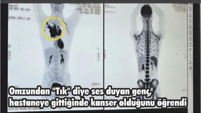 Omzundan "Tık" diye ses duyan genç, hastaneye gittiğinde kanser olduğunu öğrendi