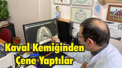 Kaval Kemiğinden Çene Yaptılar