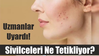 Uzmanlar Uyardı! Sivilceleri Ne Tetikliyor?
