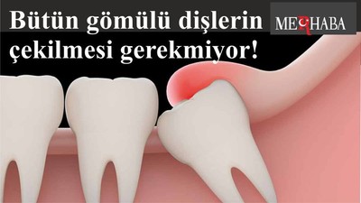 Bütün gömülü dişlerin çekilmesi gerekmiyor!
