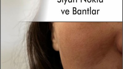 Siyah Nokta Bantları İşe Yarıyor Mu?