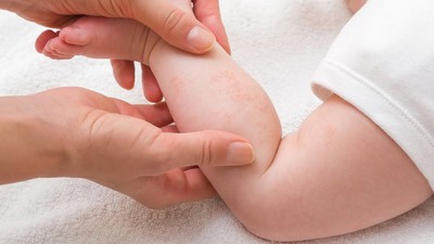 Bebeklerinizde Pişik Oluşumunu Engelleyin