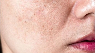 Sebum Dengesi Nasıl Korunur?
