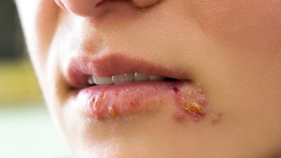 Uçuk Nedir? Nasıl Geçer?
