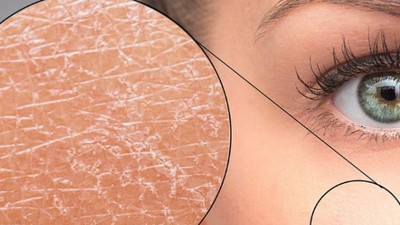 Kuru Cilt Nedir Belirtileri Nelerdir ?