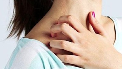Rozalı Cilt Nedir?