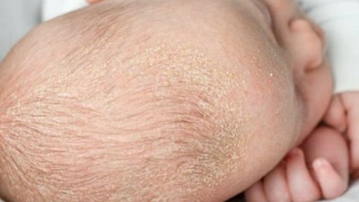 Seboreik Dermatit Hastalığı Nedir?