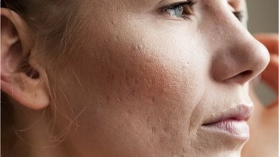 Makyajla Sivilce İzi Kapatma Yöntemleri