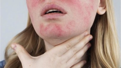 Soğuk Alerjisi Hakkında Bilinmesi Gerekenler