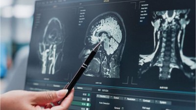 Yapay Zeka Tabanlı Alzheimer Erken Teşhis Teknolojisi