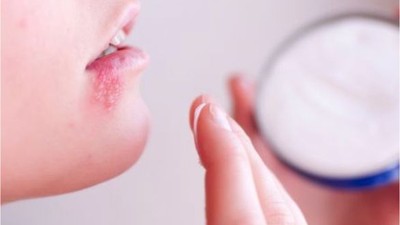 Uçuk Bakımı Nasıl Yapılır? En Hızlı Nasıl Geçer?