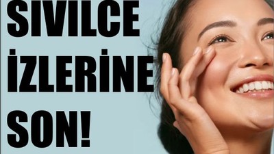 Her Gün 1 Diş Sarımsakla Sivilcelere Son!