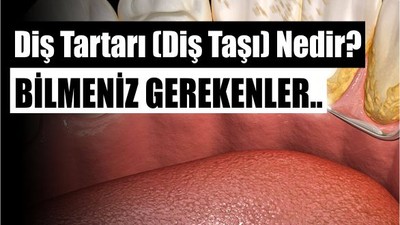 Diş Tartarı (Diş Taşı) Nedir? Zararları Nelerdir ve Nasıl Önlenir?